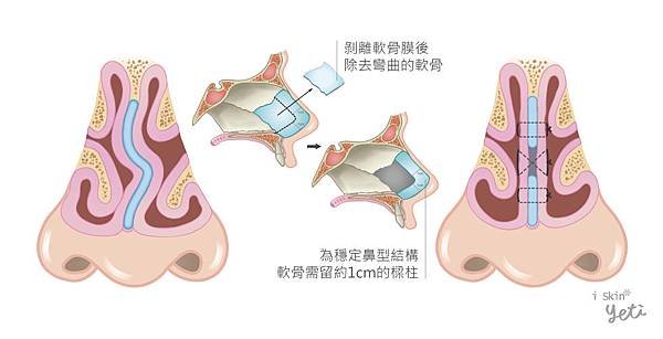 Chen-Doctor-nasal_septum2-2