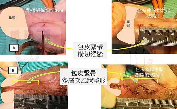 包皮繫帶的重建方式—下篇(The reconstructiv