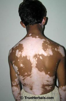 universal-vitiligo-small.jpg