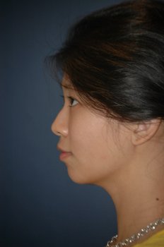 side profile before.jpg