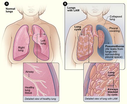 Lymphangioleiomyomatosis.jpg