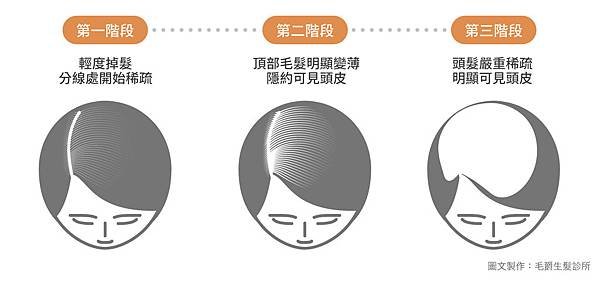 女性禿加劇落髮頭皮保養外用minoxidil女用生髮水PTT生髮水推薦價格韓式植髮筆台北植髮推薦MOJELIM毛爵生髮診所劉怡坊醫師fuefutartas植髮機器.jpg