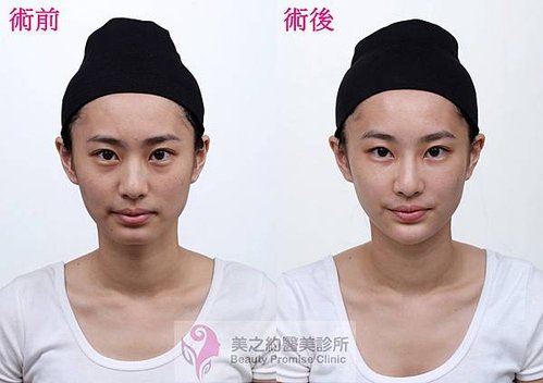 術前術後正面1.jpg