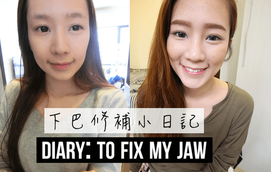 玻尿酸分享 - Diary To fix my jaw♥玻尿酸下巴修補小日記 x 張至德醫師 四個月記錄1.png