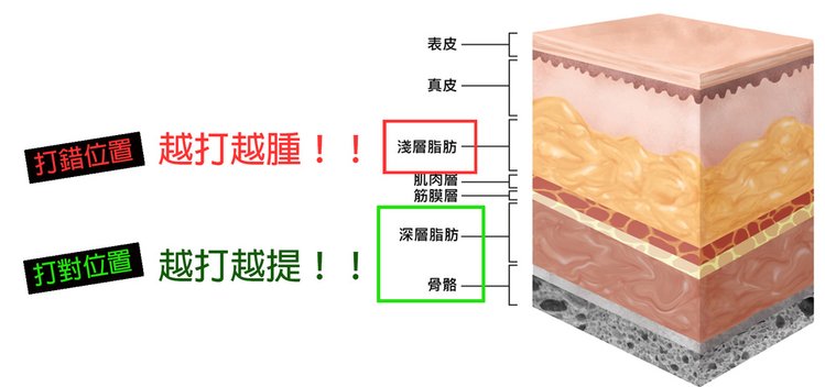 蘋果肌價錢蘋果肌凹陷下垂玻尿酸洢蓮絲舒顏萃膠原蛋白新生劑艾麗斯少女針精靈針林上立醫師推薦6.jpg