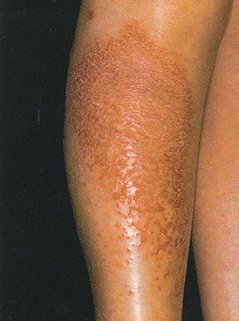 asteatotic dermatitis