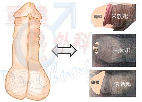 異體真皮增大的龜殼效應困擾-上篇(The turtle-sh