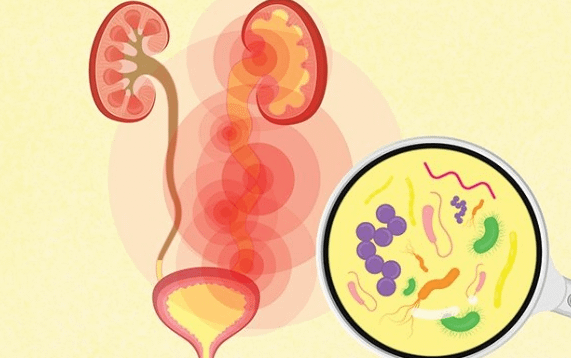 泌尿道感染：黴漿菌、尿漿菌、生殖道人型黴漿菌及其治療