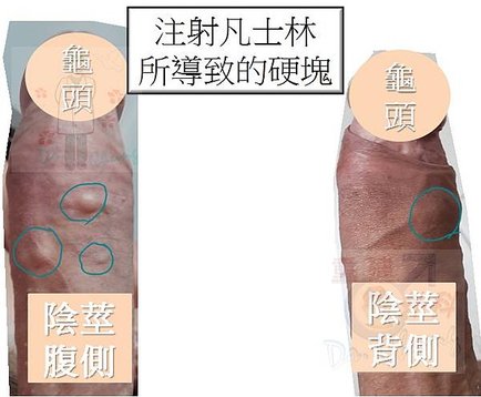 陰莖凡士林/石蠟注射(The vaseline/paraff