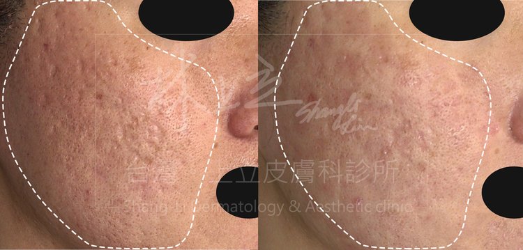 UP-laser-treatment-of-acne-scars-the-effect-must-be-better-than-Fraxel-laser (10).jpg