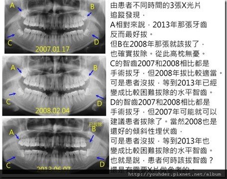 針對須手術拔除智齒的考量4