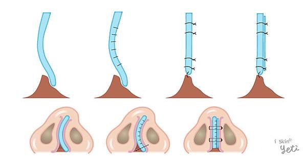 Chen-Doctor-nasal_septum2-4