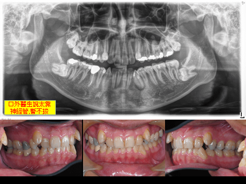 @齒顎矯正每日一說~~0213拔智齒有時不要硬拼
