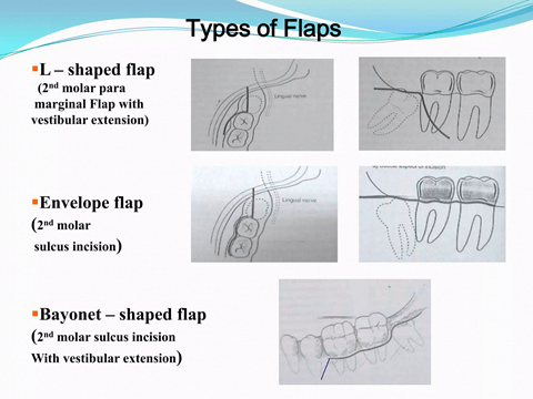 @齒顎矯正每日一說~~0217flap design of 