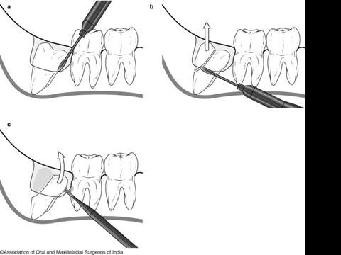 @齒顎矯正每日一說~~0220odontectomy(齒切除