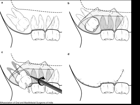 @齒顎矯正每日一說~~0220odontectomy(齒切除