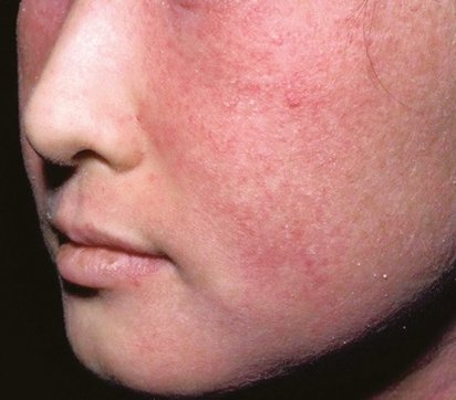 retinoid dermatitis.jpg