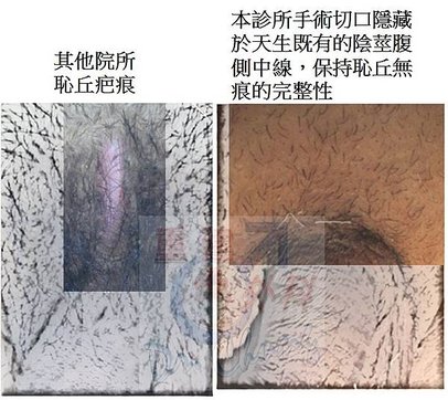 靜脈截除疤痕.jpg