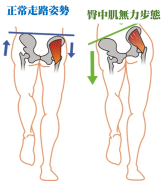 臀中肌無力.png