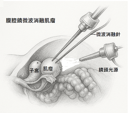 手術切除與熱消融比較說明圖表