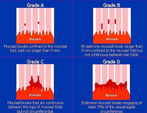 Figure-1_-LA-classification-of-erosive-esophagitis.jpg