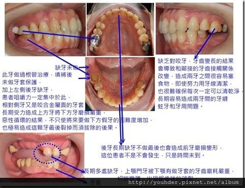 缺牙不做造成對咬牙延長