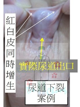 尿裂.jpg