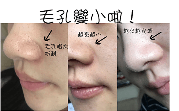 雷射除斑終於打完了，分享我怎麼保養「不反黑」！推~寶佳美「微