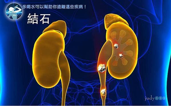 多喝水可以幫助你遠離這些疾病-結石