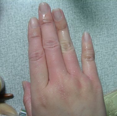 2009.04.17-燙傷.jpg