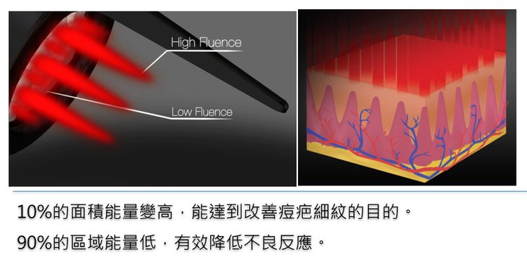 how-to-choose-Picosecond-laser-three-myth