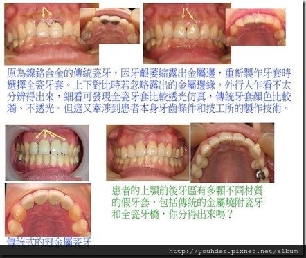 傳統金屬燒附瓷牙和全瓷牙套之比較