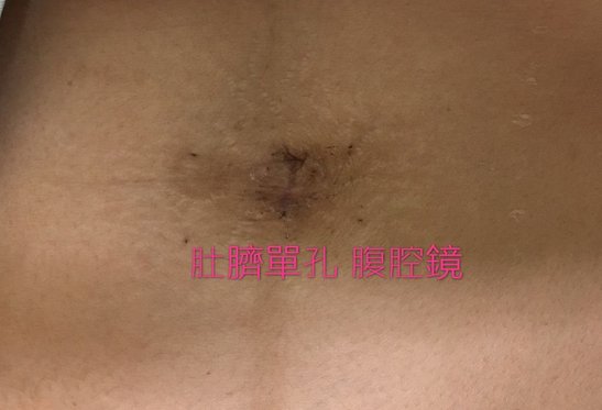 單孔 腹腔鏡傷疤 約第三週.JPG