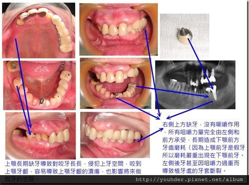 缺牙造成原有假牙壽命變短