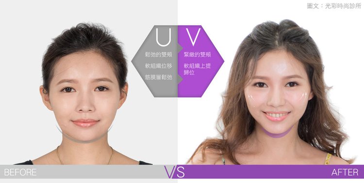埋線拉提失敗埋線拉提費用埋線拉提副作用埋線拉提ptt埋線拉提推薦埋線拉提後遺症埋線拉提術後埋線拉提恢復期臉部埋線拉提費用中醫埋線拉提雙下巴醫美雙下巴.jpg