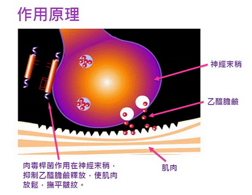 FireShot Capture 900 - 肉毒桿菌-瘦小臉_除皺_瘦小腿_動態紋_全臉拉提-微整權威-愛玩美診所 - iperfect.com.tw