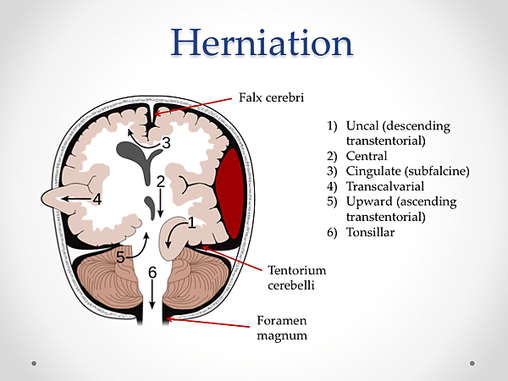 Brain-Herniation-2.png