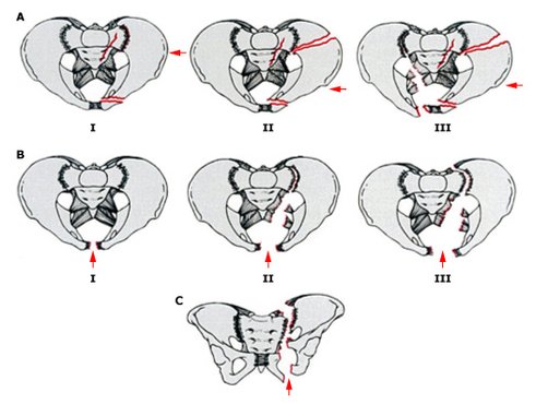 Pelvic_ring_fx_scheme.jpg