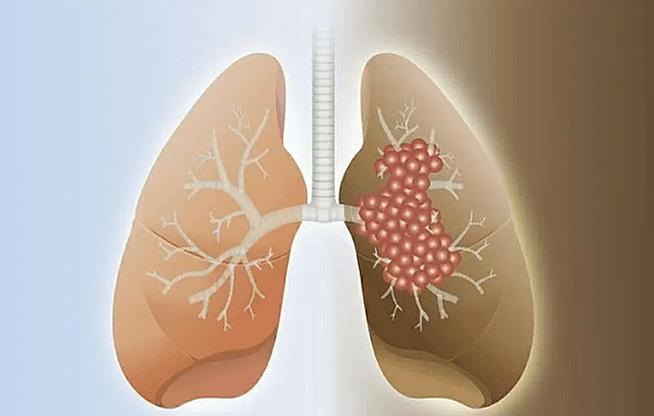 撞球天才楊清順因肺癌離世 ! 肺癌的症狀與風險因素