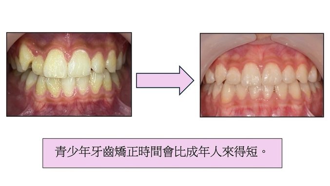 「牙齒矯正」牙齒矯正需要多久時間？