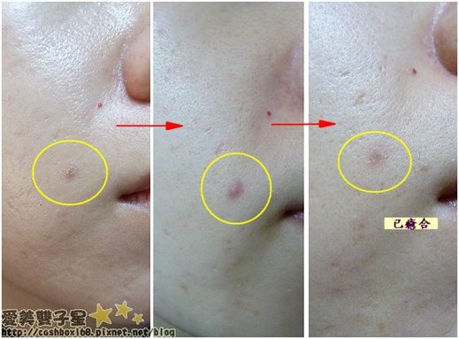 burt&apos;sbees清痘夫13.jpg