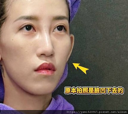 台北音波拉提診所分享 愛爾麗診所 𝐇𝐢𝐏𝐑𝐎-𝐒 龍捲風音波