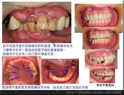 缺牙未處理，造成其他區牙齒受力過大而磨耗嚴重