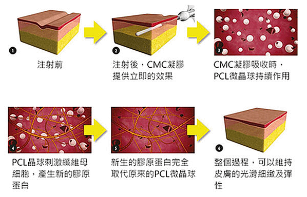 舒顏萃、洢蓮絲、艾麗斯 3種膠原蛋白增生劑大不同