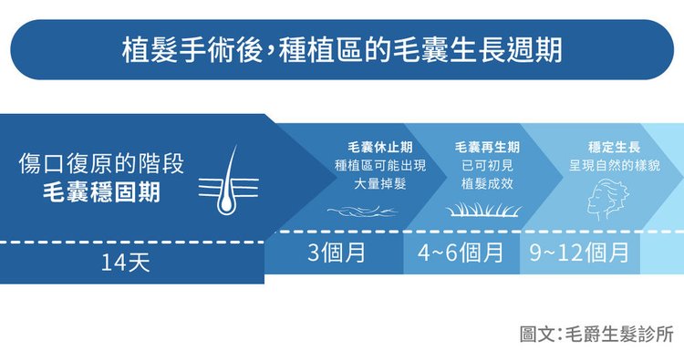 台北植髮推薦植髮成功率植髮有用嗎植髮後生髮水植髮效果雄性禿m型禿地中海禿頭治療禿頭怎麼辦 (2).jpg