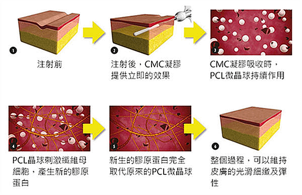 洢蓮絲PCL完美晶球 打造秀氣動人的臉龐