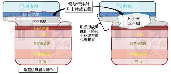 陰莖注射凡士林/石蠟的處理架構(The treatment 