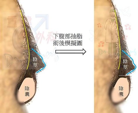 異體真皮增大的龜殼效應困擾-中篇(The turtle-sh