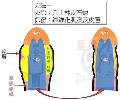 陰莖注射凡士林/石蠟的處理架構(The treatment 