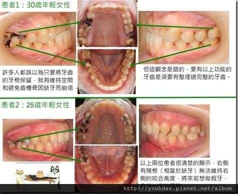 缺牙導致牙齒咬合高度下降